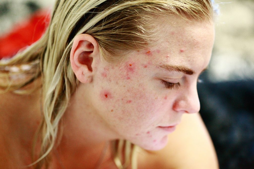Face of a girl with acne problems.