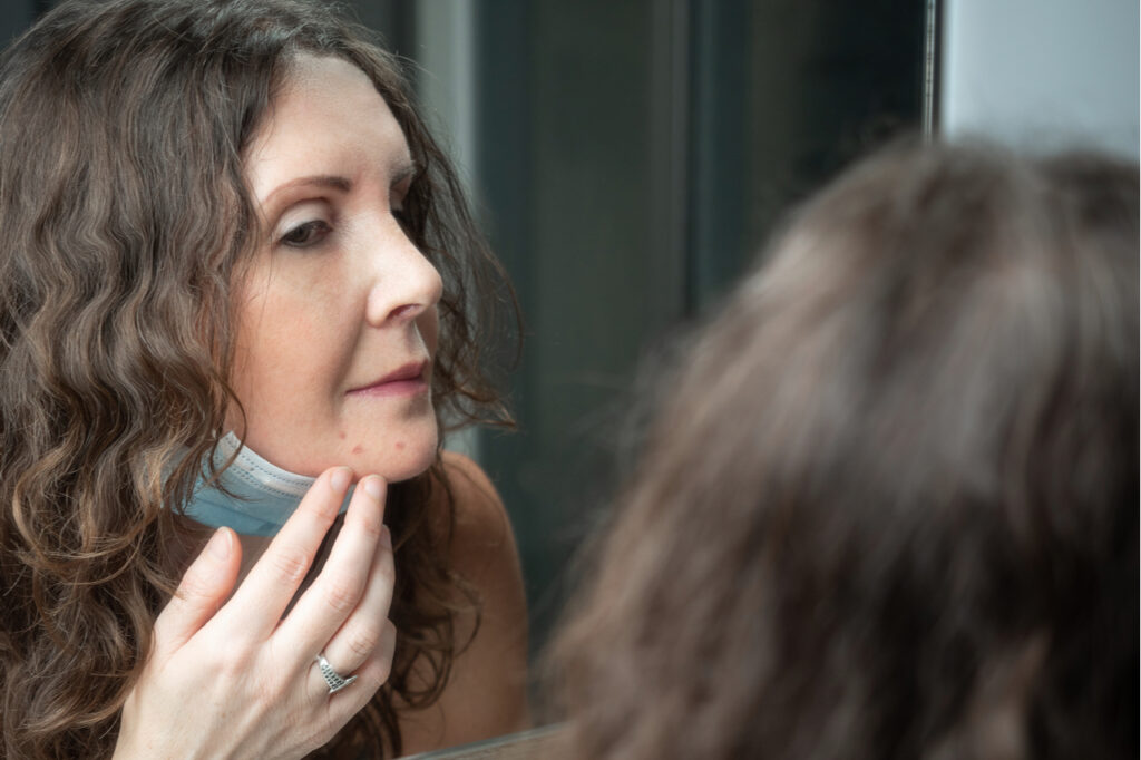 Woman suffering with maskne on her chin after wearing protective face mask.