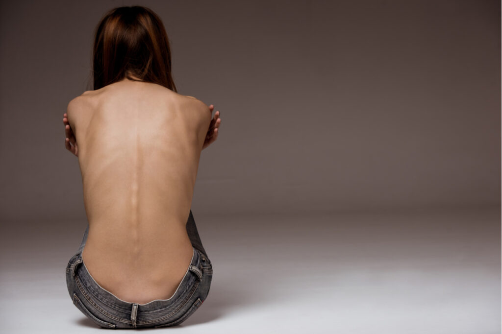 A girl with anorexia turned back, spine and ribs visible