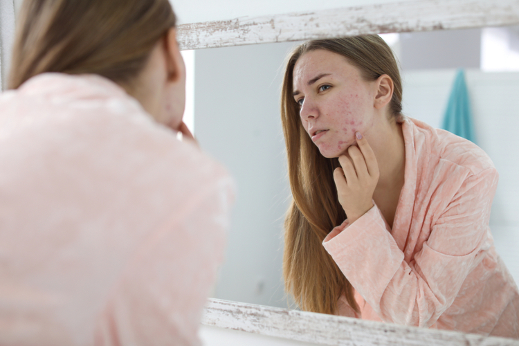 Young woman with acne problem near mirror in bathroom.