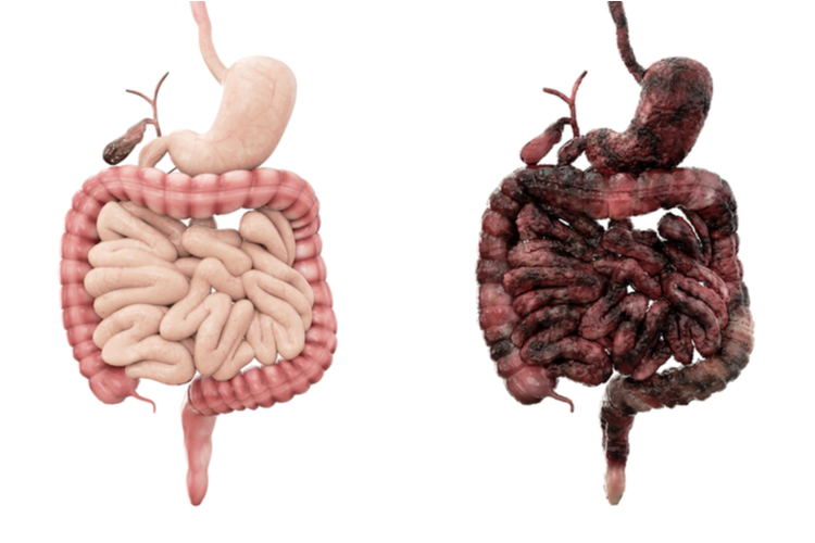 The effects of cigarette smoking is disease intestines